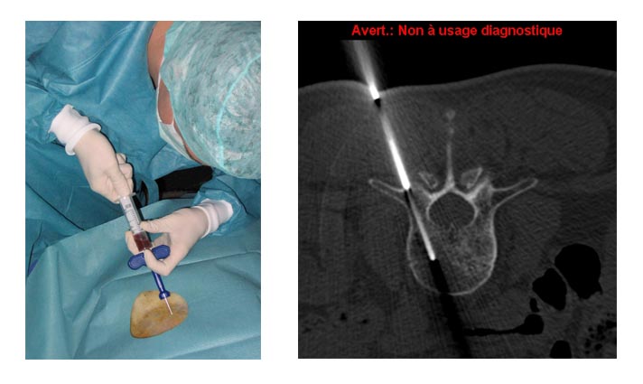 biopsy